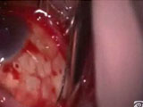 Scleral Buckling Procedure