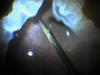 Giant Retinal Tear With Proliferative Vitreoretinopathy