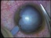 Intumescent Traumatic Cataract
