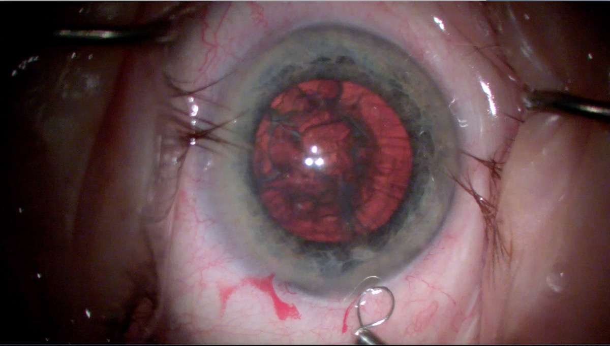 miLOOP Training: Temporal Two-handed Technique on Gummy/Rubbery Nucleus