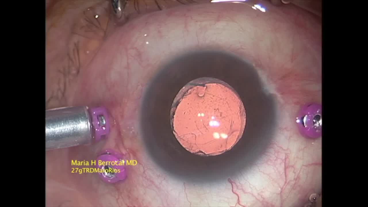 27G Probe Technique for Peeling ERM/ILM