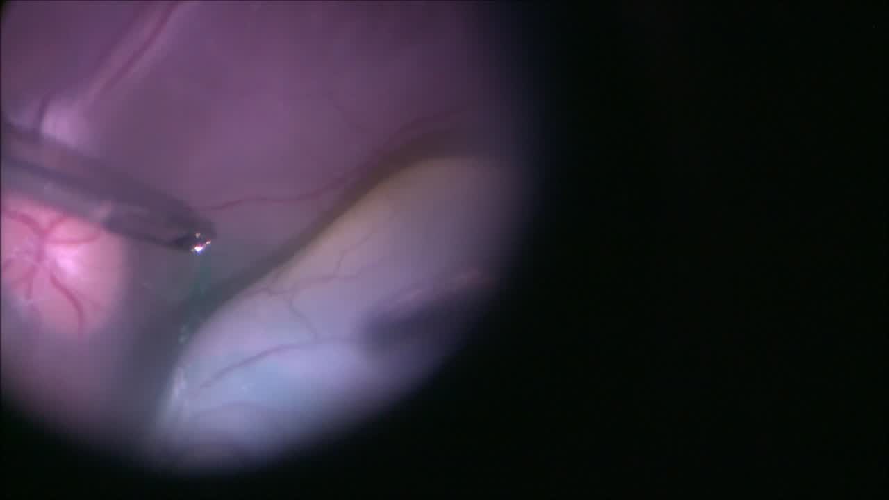 Hyaloid Elevation and An Irregular Retinectomy Edge