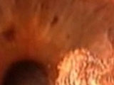 ART of Recurrent Pterygium surgery