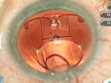 Microincisional Phaco of Posterior Subcapsular Cataract