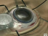 Endothelial Keratoplasty: Please Dont Fold