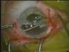 Pupil Reconstruction 
