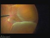 Macular Fold...
