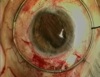 New Techniques for Scleral Fixation - Part 1