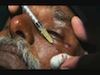 Botulinum Toxin Injection for Hemifacial Spasm - Eyetube