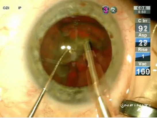 Low Parameters With Dense Cataracts