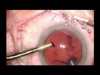 MICS With Implantation of a Trifocal Diffractive IOL