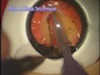 Kitaro DryLab and WetLab - Revolutionary Training Tool for Cataract Surgery