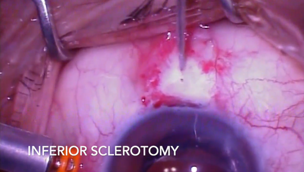 Scleral Fixation of Dexamethasone Implant