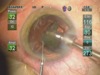 +4 Cataract Removal with OZil IP
