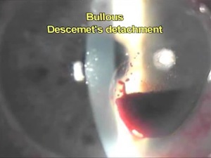 Descemet's Detachment Classification & Relaxing Descemetotomy