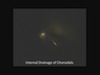 Suprachoroidal Hemorrhage
