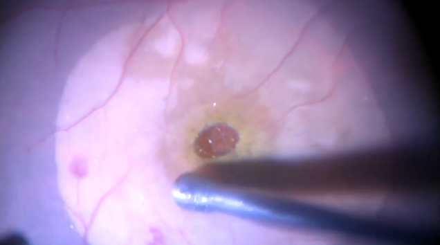Macular Hole Surgery: Retinal Massager