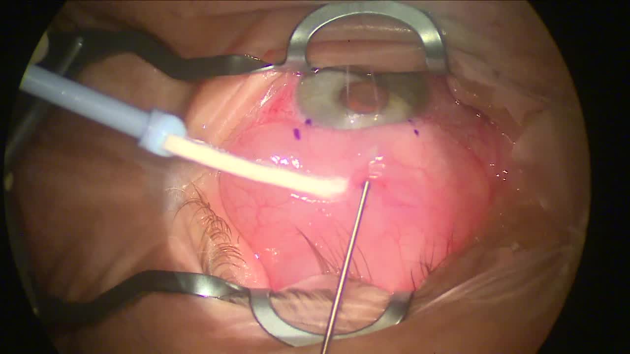 XEN Implantation Tips From Dr. Smith