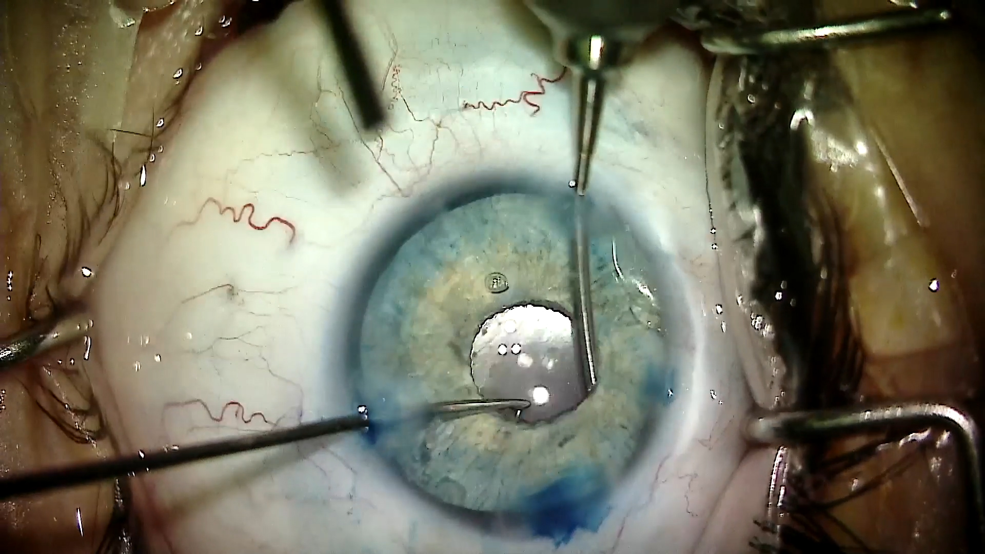 A Complicated Search for Blue Eyes