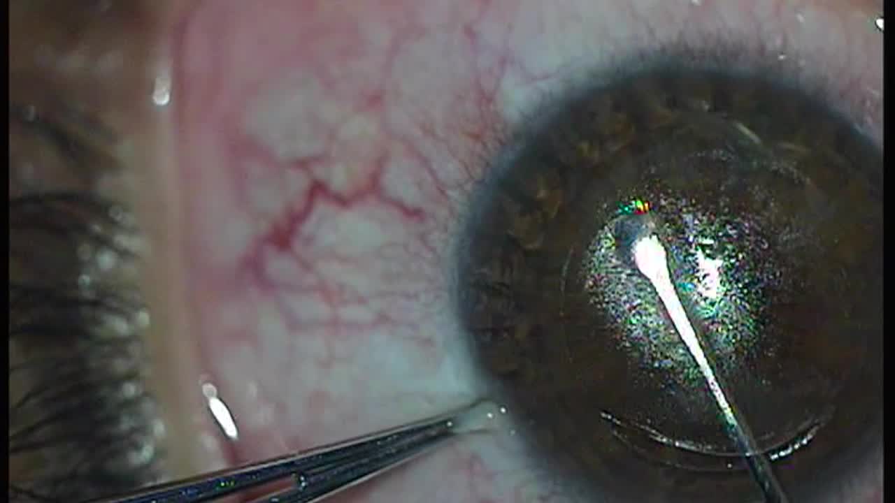 Watch a SMILE Procedure in Less Than 30 Seconds