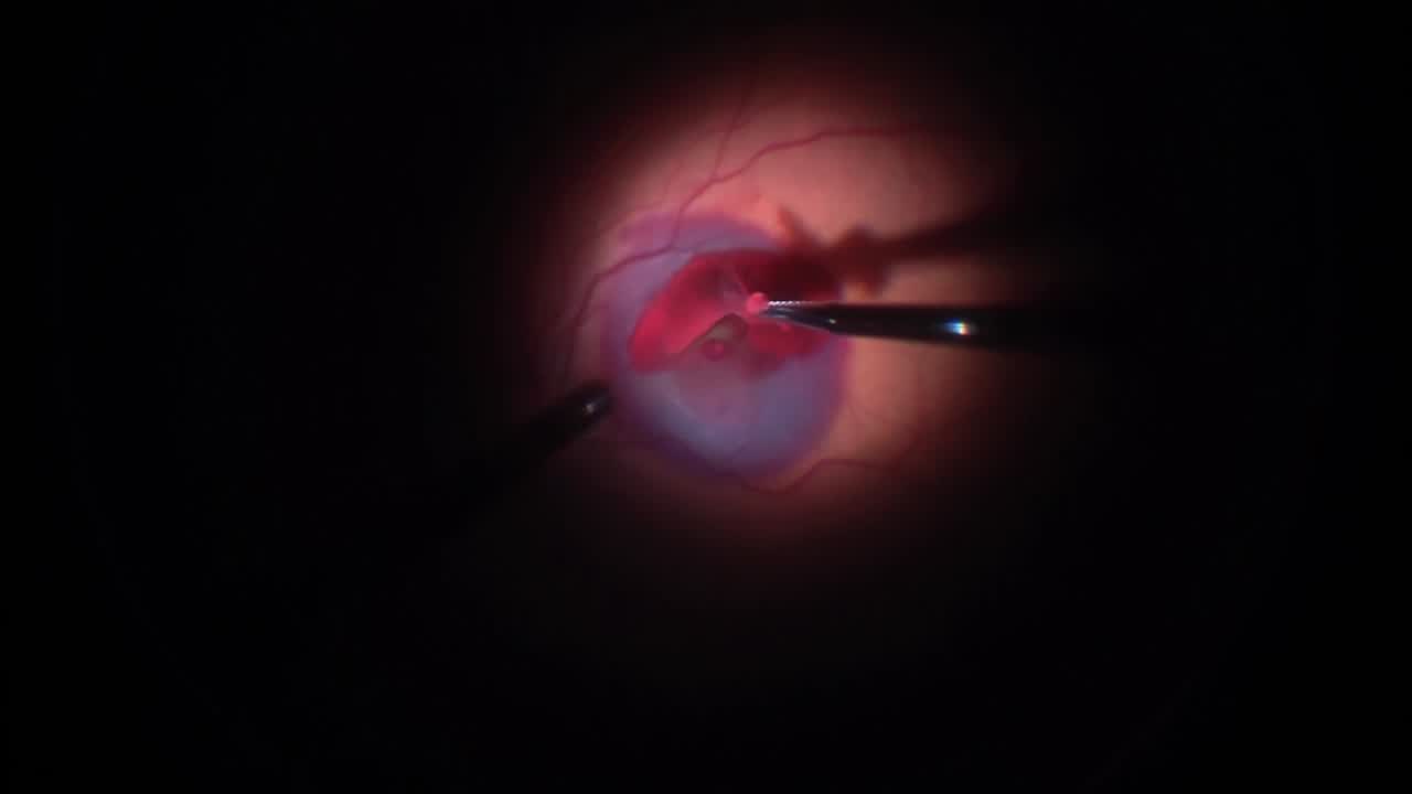 Macroaneurysm