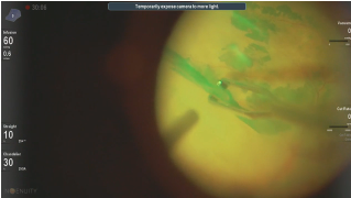 Epiretinal Membrane and Internal Limiting Membrane Peel
