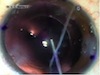 Traumatic Cataract and Corneal Tear with Toric IOL Implantation
