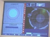 Femtosecond Laser for Lasik