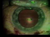 A continuous circular anterior capsulotomy under sodium hyaluronate