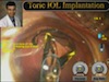 Pearls for AcrySof ReSTOR Toric and AcrySof Toric IOL Implantation