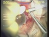 Sclerotomy Closure