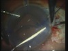 Glued IOL Technique in a Live Surgery