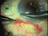 Trabeculectomy or Express Shunt Running Locking Closure