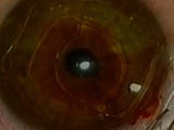 Myopic phakic implantation
