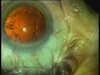 Trifocal Lens Implantation