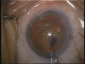 Phacoemulsification in a Patient with True Exfoliation Syndrome