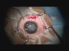 IOL Implantation with Cionni CTR in Subluxated Traumatic Cataract in Pediatric Patient