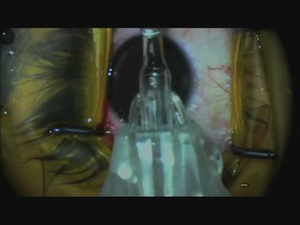 Visian ICL Preloaded: The First Implant