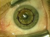 Conductive Keratoplasty