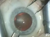 Biaxial MICS using the Stellaris and Akreos Implant