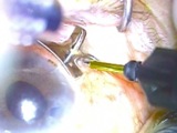 Sutureless 20G Vitrectomy