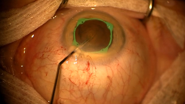 Managing Small Pupils With I-Ring
