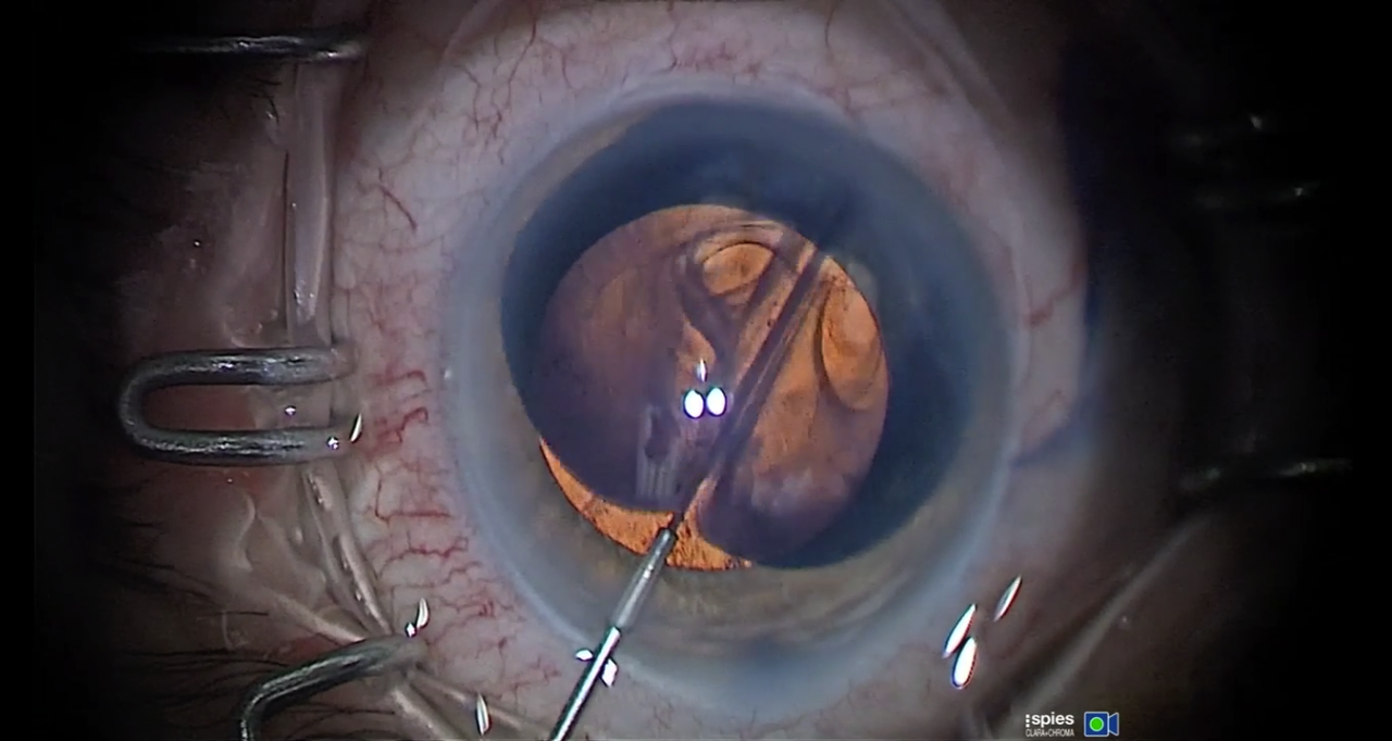 Staining the Trabecular Meshwork with Vision Blue to Enhance iStent Implantation