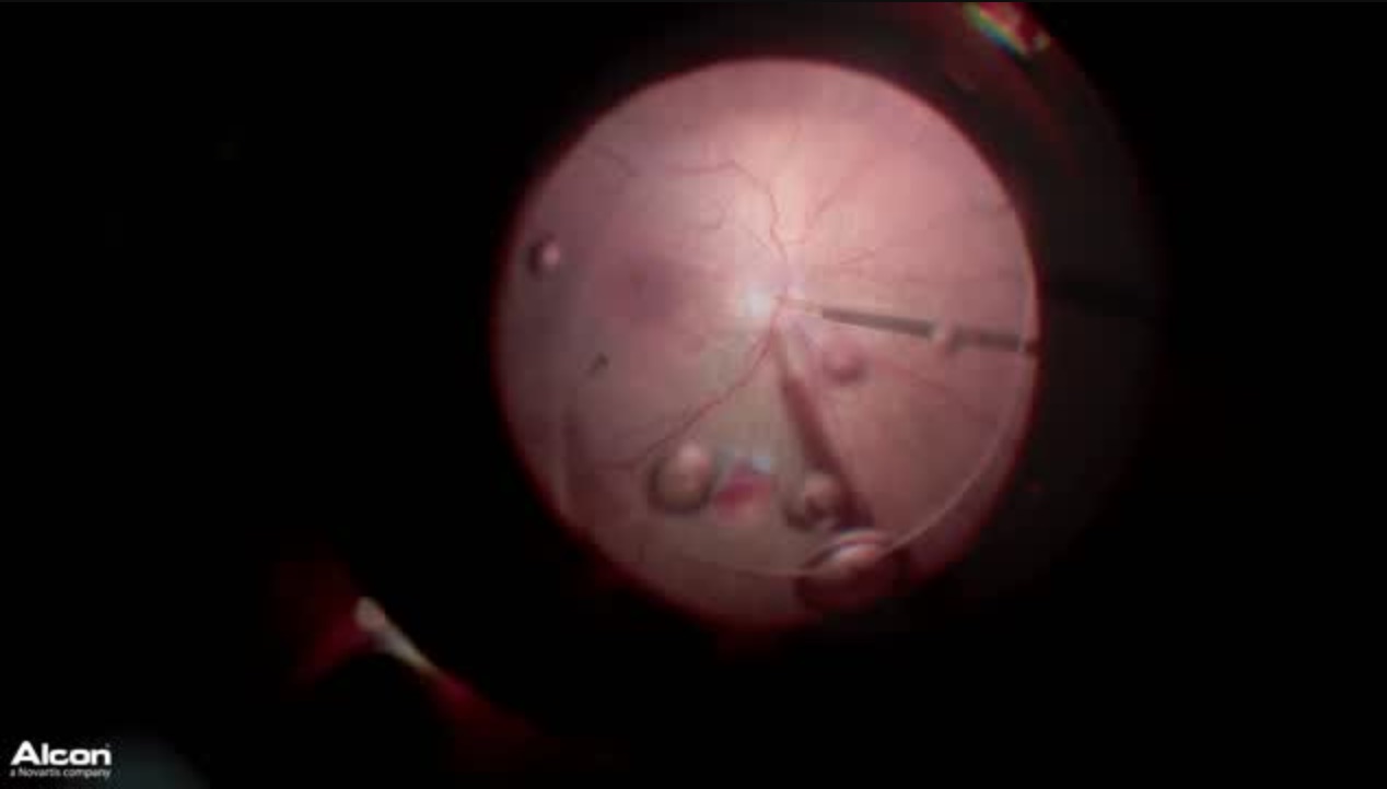 Autologous Retina Transplant
