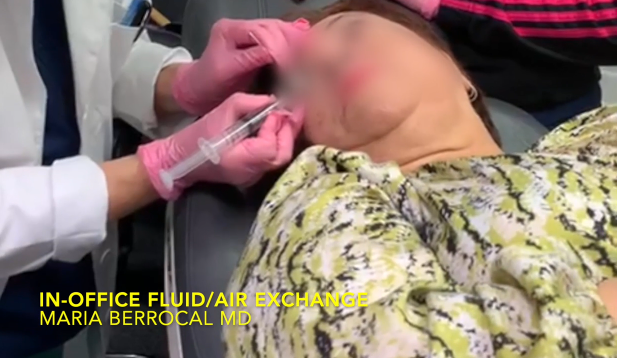 In-Office Fluid/Air Exchange