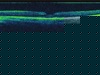 Intraoperative Spectral Domain OCT