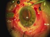 Posterior Chamber IOL Placement or Rescue Via a Sutureless Scleral Fixation Technique