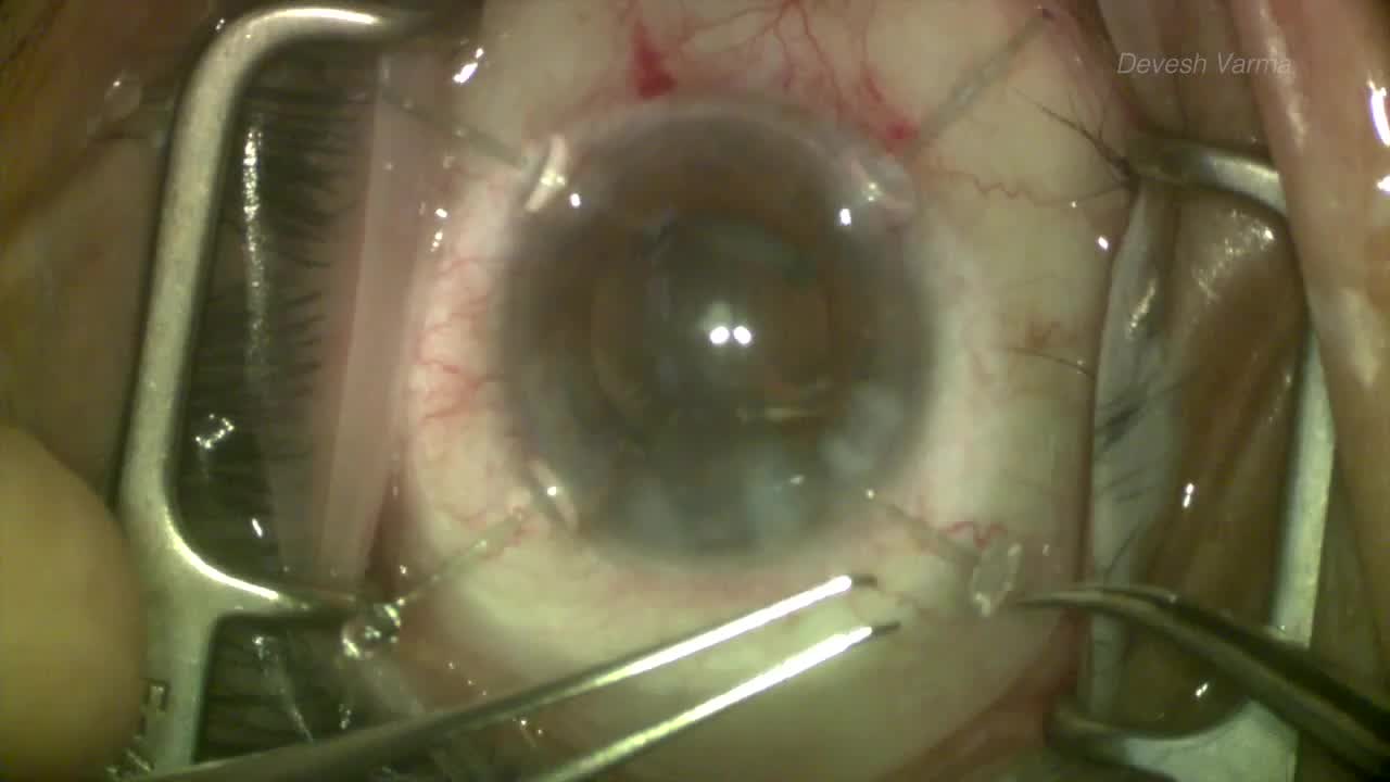 Phaco for a Dense Lens with Zonulopathy Using Capsule Hooks