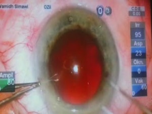Tackling Hard Cataracts