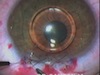 ZSAL-4/PLUS Phakic Refractive Lens